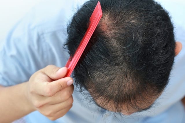 Nguyên nhân rụng tóc ở nam phổ biến nhất chính là do hormone DHT và di truyền